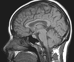 Brain MRI