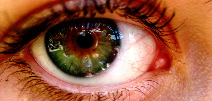 Major Cause Of Blindness Linked To Calcium Deposits In The Eye