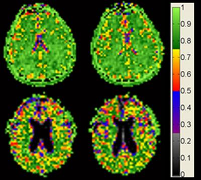 Brain cell density remains constant with age among cognitively normal adults. (Courtesy of Dr. Keith Thulborn)