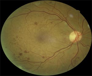 Scan of a diabetic eye