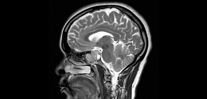 Mri Shows Brain Differences Among Adhd >> Mri Shows Disrupted Connections In The Brains Of Young Mri Shows Brain Differences Among Adhd >> Mri Shows Disrupted Connections In The Brains Of Young