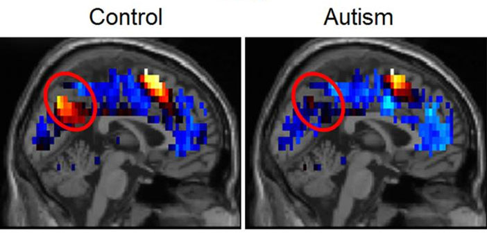Autism Shares Brain Signature With >> Brain Representations Of Social Thoughts Accurately Predict Autism Autism Shares Brain Signature With >> Brain Representations Of Social Thoughts Accurately Predict Autism