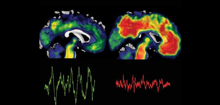 Poor sleep linked to toxic buildup of Alzheimer's protein, memory loss