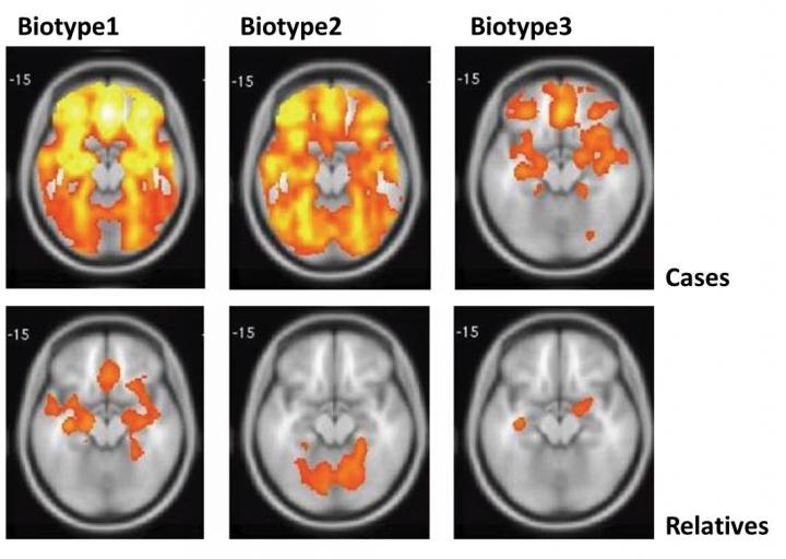 MRI scans showed that people with psychosis had different patterns of reduced gray matter -- neurons and their connections, the brain's working tissue (orange/yellow) -- depending on their biotype. 