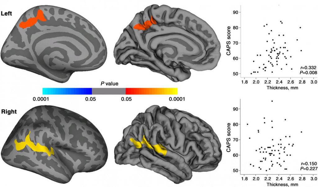 Maps of statistically significant cortical thickness differences between patients with PTSD and healthy survivors and of relationships between CAPS scores and cortical thickness in regions where significant cortical thickness changes were observed in patients with PTSD. Clusters of significantly increased cortical thickness were projected onto the inflated surface of the hemisphere. The first row shows the cluster located in the left precuneus, and second row shows the cluster located in right superior temporal gyrus extending to the inferior parietal lobule. Scatter plots show the averaged cortical thickness within the significant clusters and CAPS scores for patients with PTSD.