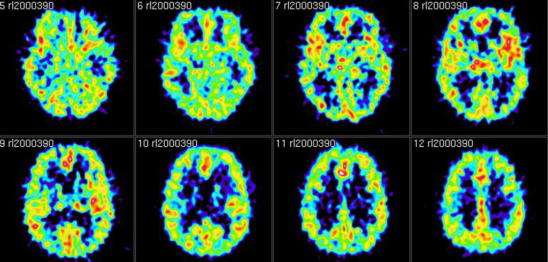 New PET scan tracer allows first imaging of the of the