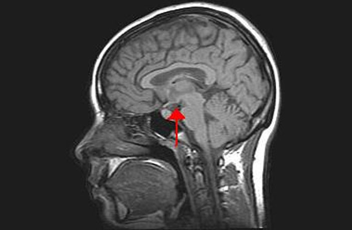 Location of the hypothalamus in the brain  (Photo credit: Wikimedia Commons)