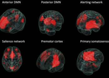 These maps show networks in the brains of controls and patients with temporal lobe epilepsy.  (Photo credit: Vannucci Lab/Rice University)