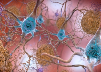 In the Alzheimer’s affected brain, abnormal levels of the beta-amyloid protein clump together to form plaques (seen in brown) that collect between neurons and disrupt cell function. Abnormal collections of the tau protein accumulate and form tangles (seen in blue) within neurons, harming synaptic communication between nerve cells. (Photo credit: NIH)