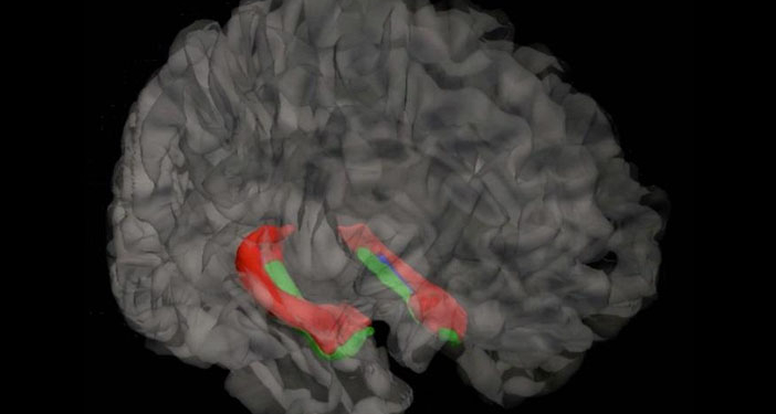 This image shows the hippocampus. (Photo credit: Dr. Neda Bernasconi)