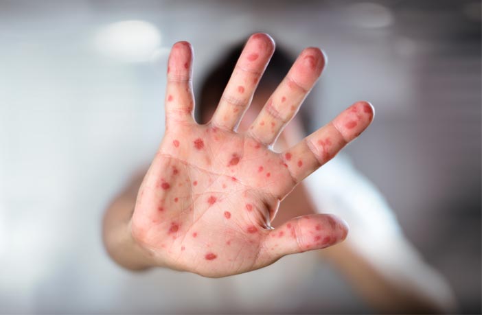 Study finds a link between infectious diseases and racism in the United