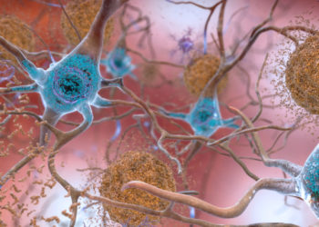 Abnormal levels of the beta-amyloid protein clump together to form plaques (seen in brown) that collect between neurons and disrupt cell function. Abnormal collections of the tau protein accumulate and form tangles (seen in blue) within neurons, harming synaptic communication between nerve cells. (Photo credit: NIH)