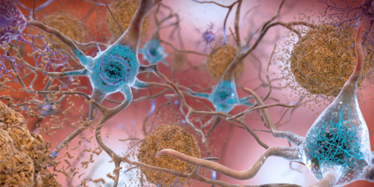 Abnormal levels of the beta-amyloid protein clump together to form plaques (seen in brown) that collect between neurons and disrupt cell function. Abnormal collections of the tau protein accumulate and form tangles (seen in blue) within neurons, harming synaptic communication between nerve cells. (Photo credit: NIH)