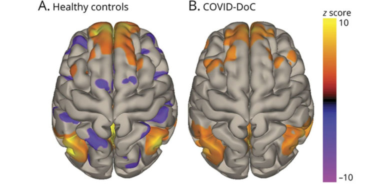 Functional brain connectivity for patients with COVID-19 disorders of consciousness compared to healthy controls.