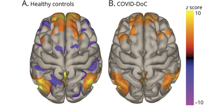 Functional brain connectivity for patients with COVID-19 disorders of consciousness compared to healthy controls.