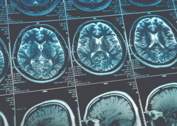 Even mild cases of COVID-19 might result in brain shrinkage and impaired cognitive function