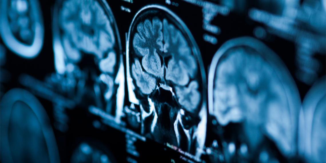 Study links vitamin D deficiency to accelerated brain aging