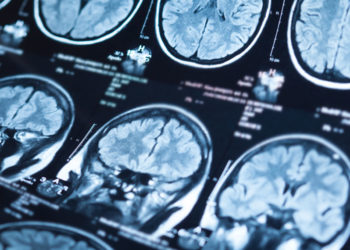 Neuroimaging study finds gray matter reductions in first-time fathers