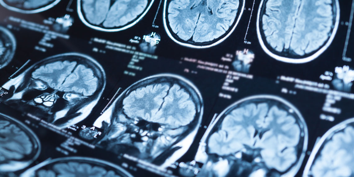 Pesquisas em neurociência ligam problemas de sono ao envelhecimento acelerado do cérebro em idosos