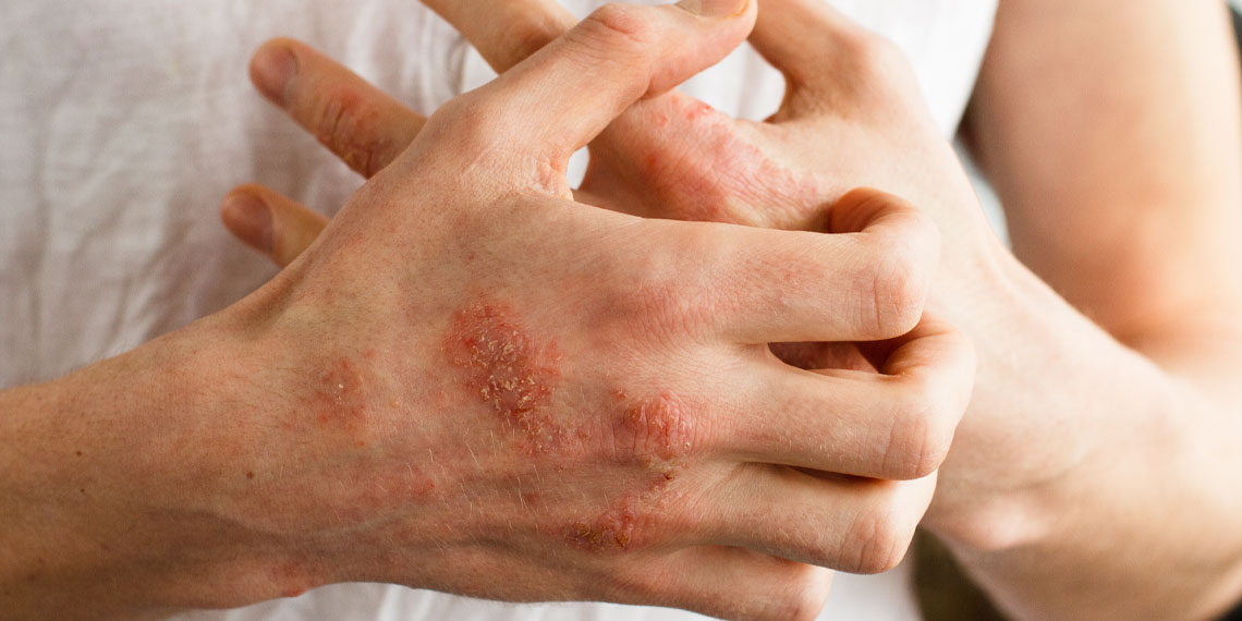 Eczema linked to increased symptom severity in children with autism