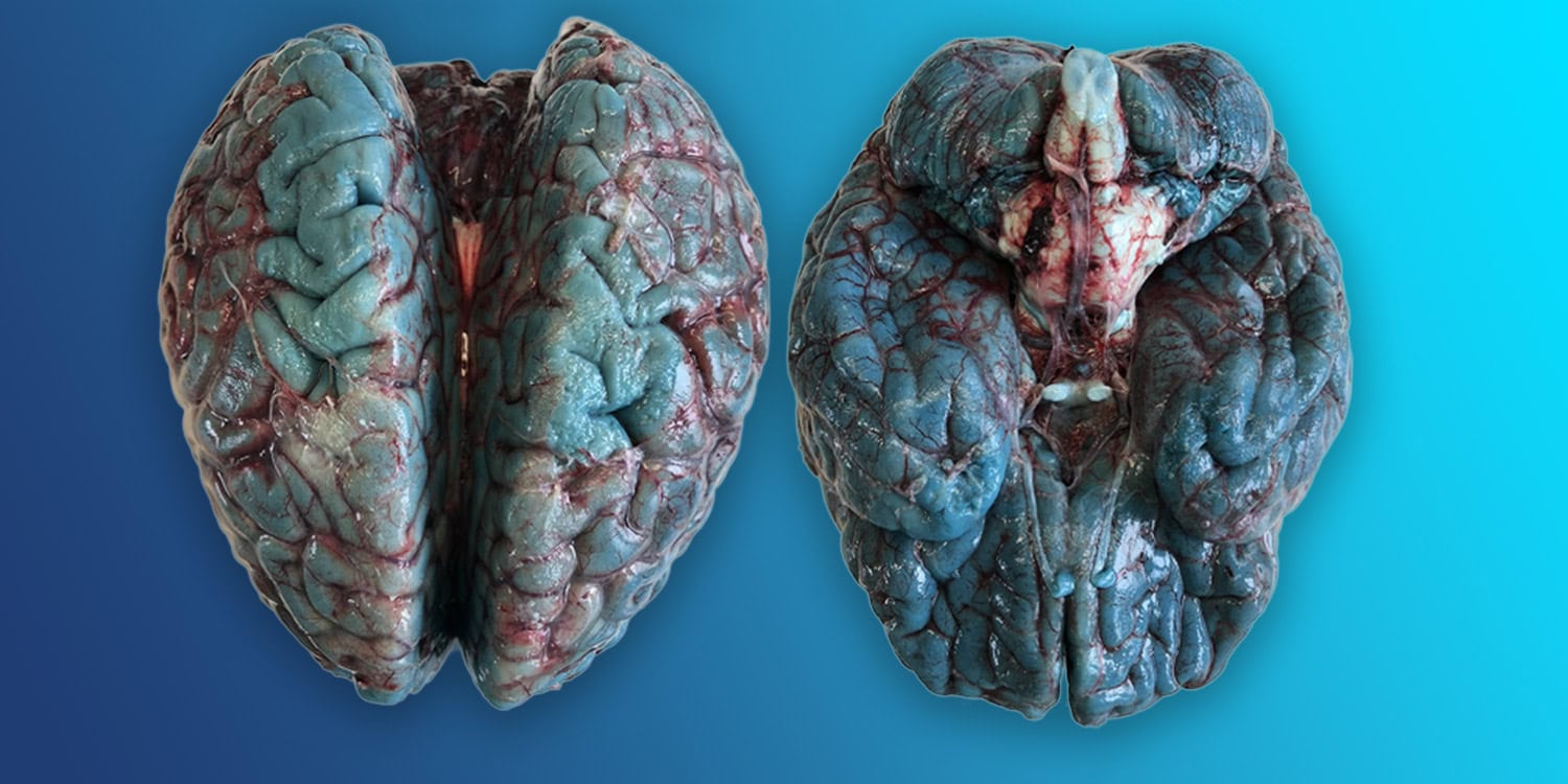 Autopsies revealed mysterious blue-colored brains - now scientists know what caused it