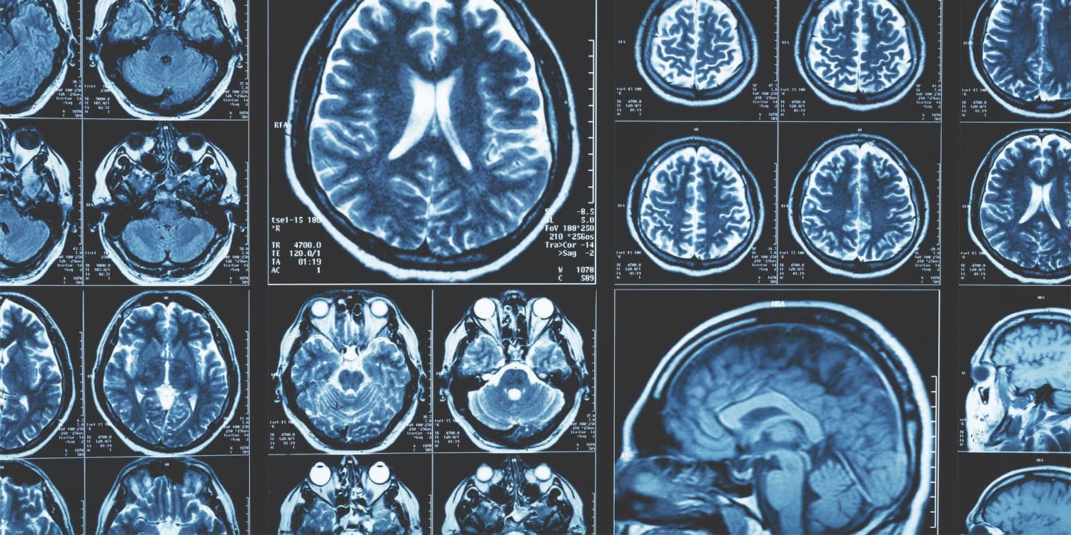 Your brain isn't just shrinking with age, it's doing something much stranger