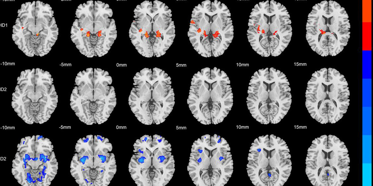 Brain scans reveal two distinct physical subtypes of ADHD - PsyPost
