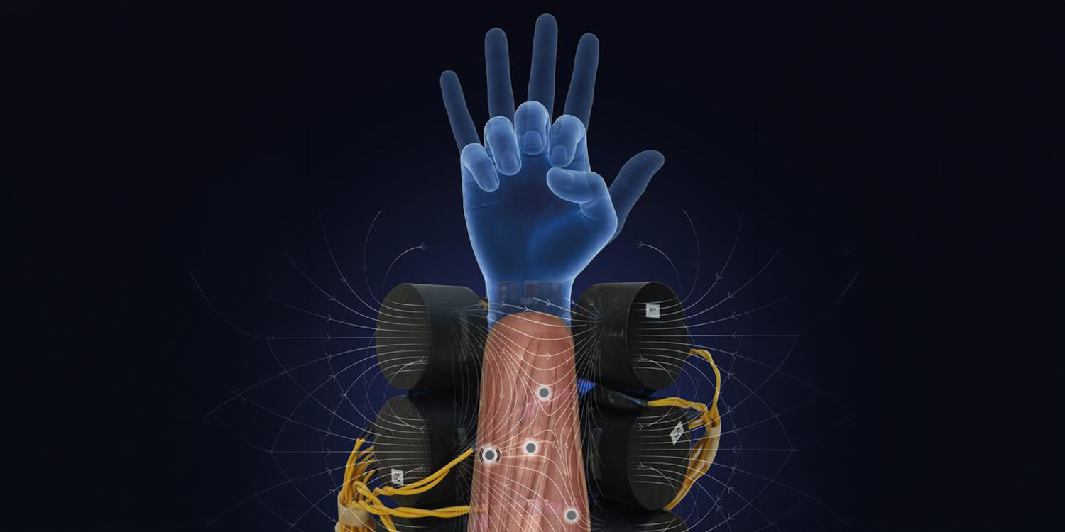 Magnetic muscle implants help amputees feel coordinated prosthetic hand movements